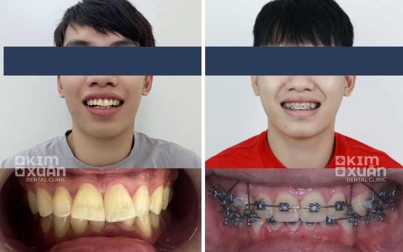 Niềng Răng Hô Nhẹ Giá Bao Nhiêu