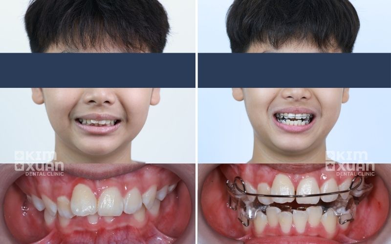 Niềng Răng Hô Nhẹ Tại Nha Khoa Kim Xuân
