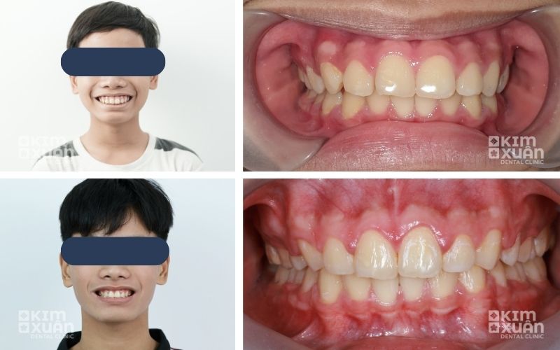 Niềng Răng Hô Tại Nha Khoa Kim Xuân