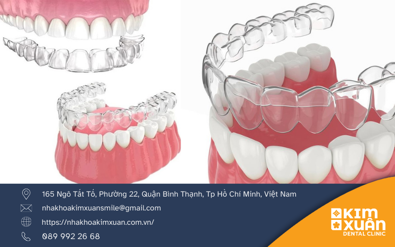 Niềng Răng Invisalign Là Gì?
