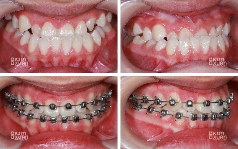Niềng răng khớp cắn ngược tại nha khoa kim xuân