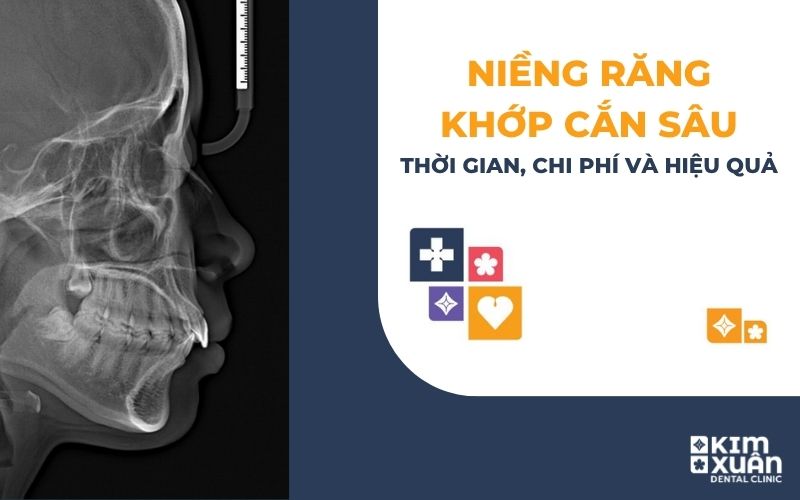 Niềng răng khớp căn sâu
