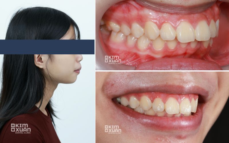 Niềng răng khớp cắn sâu tại nha khoa kim xuân