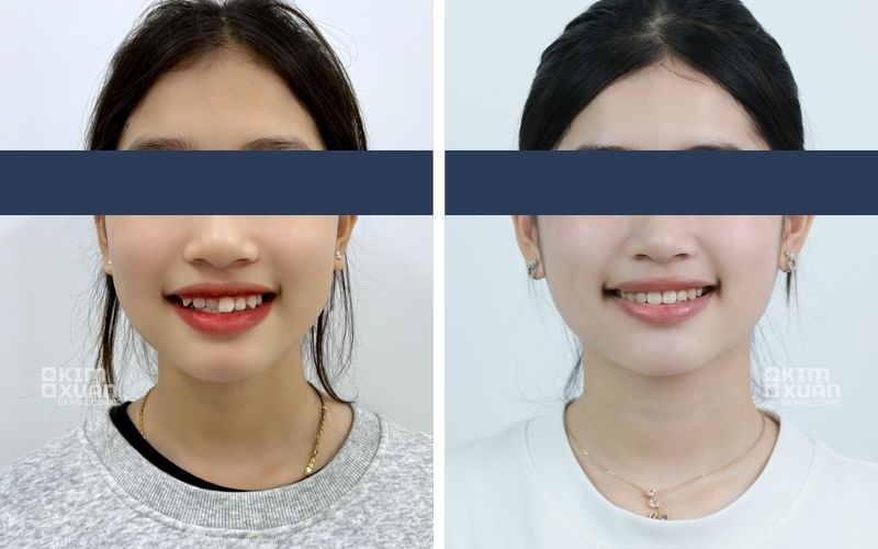 Niềng Răng Lệch Lạc Giá Bao Nhiêu Tiền