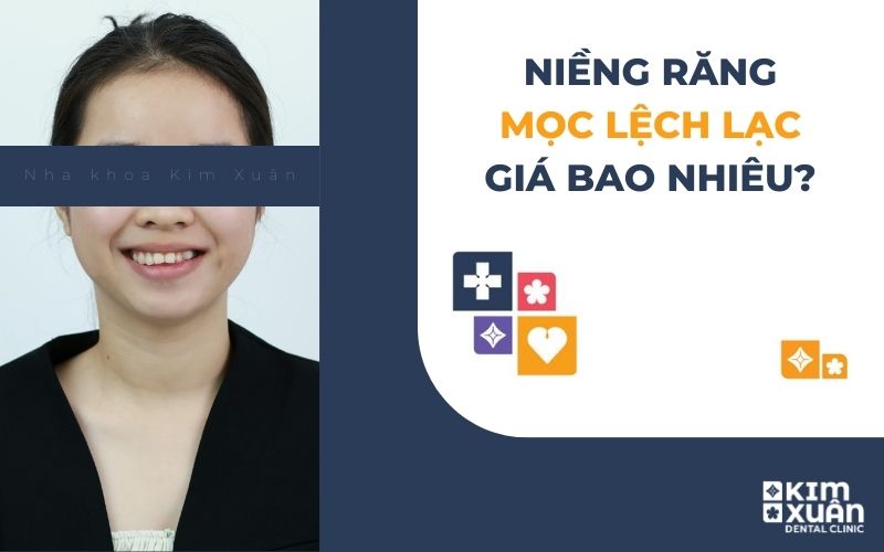 Niềng Răng Lệch Lạc Giá Bao Nhiêu