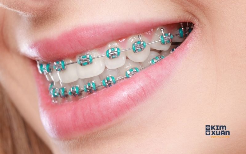 Niềng Răng Mắc Cài Kim Loại