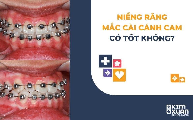 Niềng răng mắc cài cánh cam có tốt không