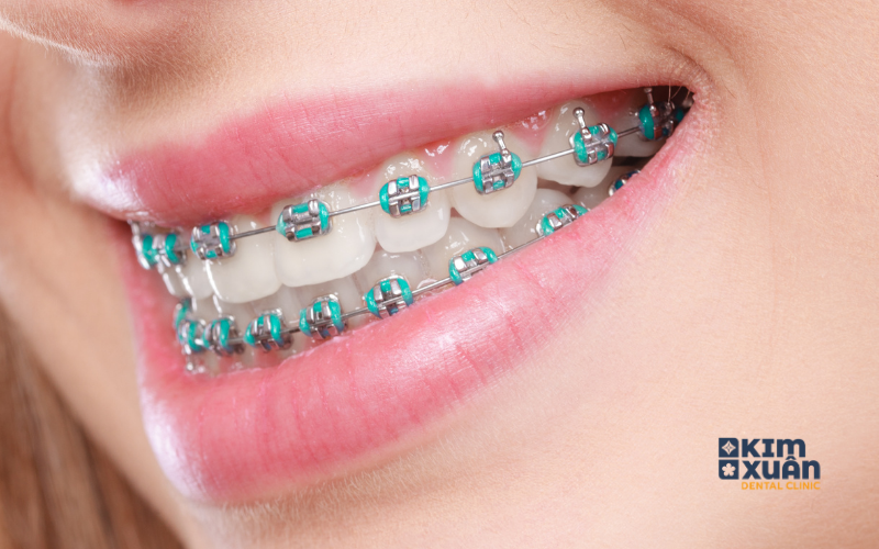 Niềng Răng Mắc Cài Kim Loại