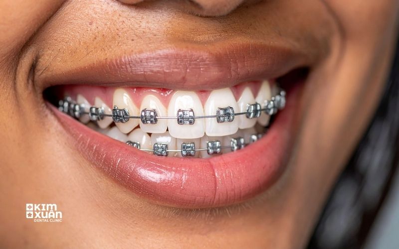 Niềng Răng Mắc Cài Kim Loại
