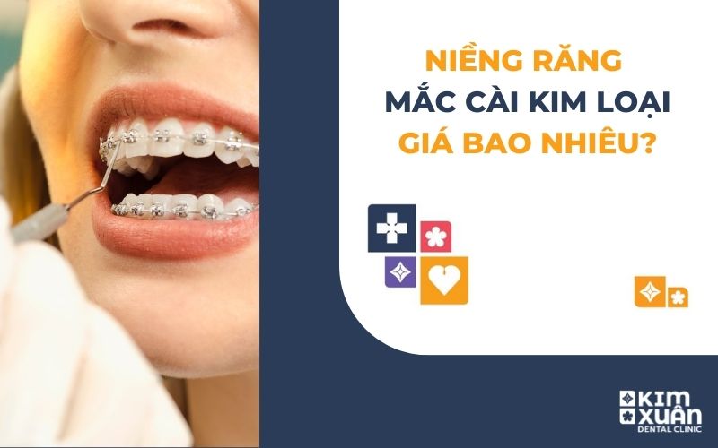 Niềng Răng Mắc Cài Kim Loại Giá Bao Nhiêu