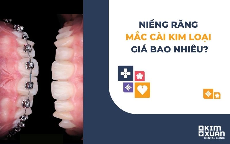Niềng Răng Mắc Cài Kim Loại Giá Bao Nhiêu