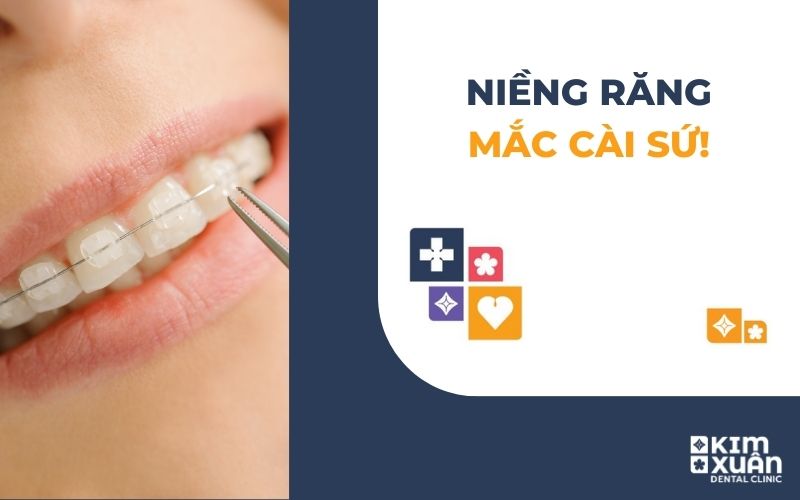 Niềng Răng Mắc Cài Sứ
