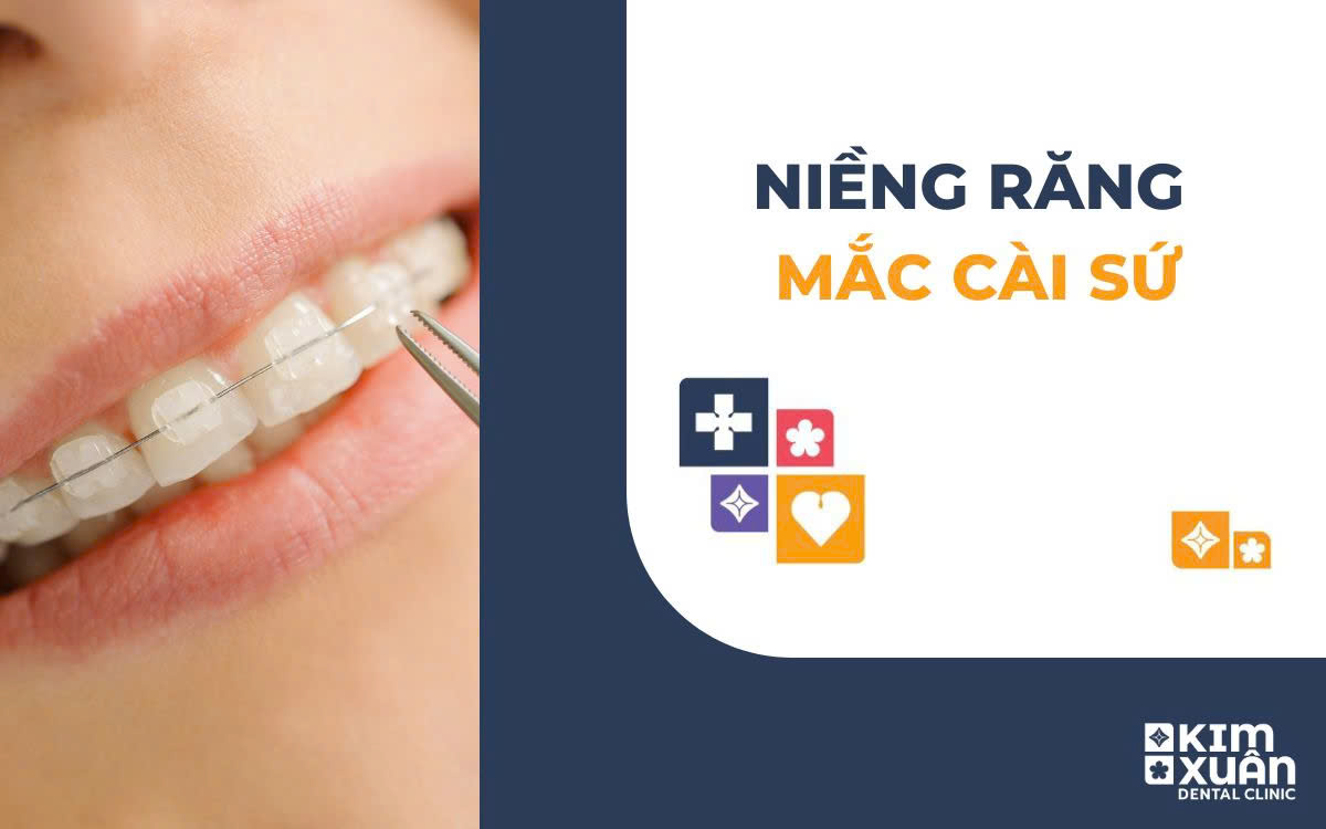 Niềng Răng Măc Cài Sứ