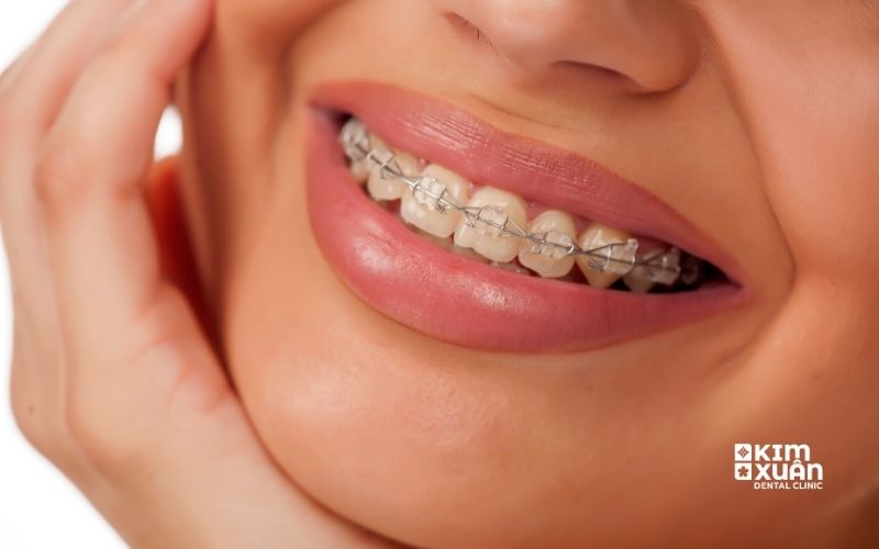 Niềng Răng Mắc Cài Sứ Là Gì