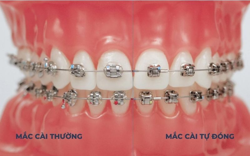 Niềng Răng Mắc Cài Thường Và Niềng Răng Mắc Cài Tự Buộc