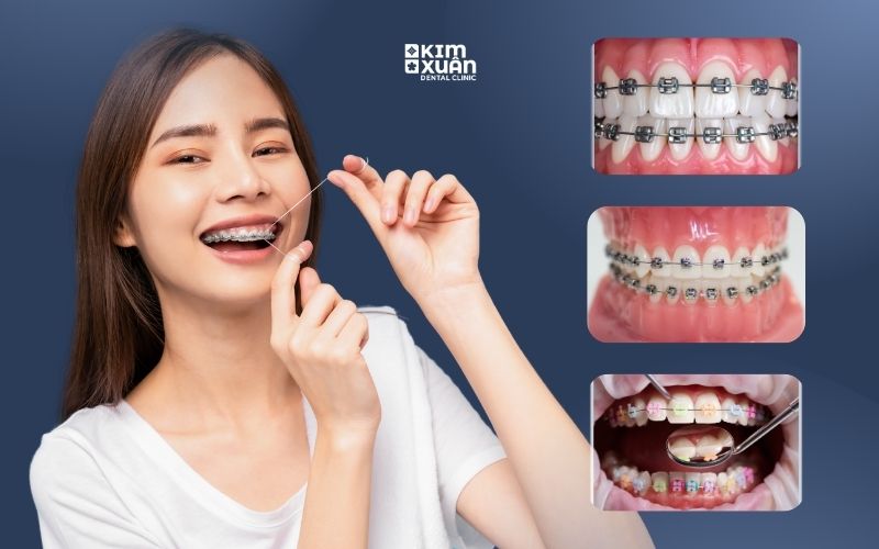 Niềng Răng Mắc Cài Trả Góp