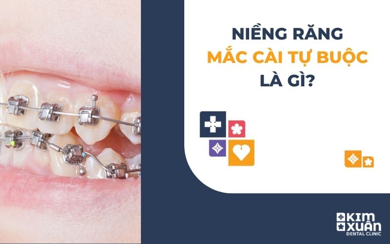 Niềng Răng Mắc Cài Tự Buộc