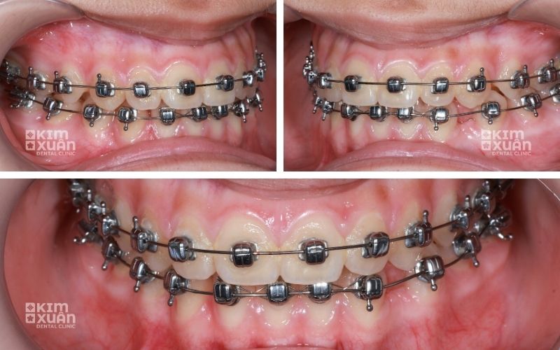 Niềng Răng Mắc Cài Tự Buộc Bao Nhiêu Tiền Tại TP. HCM