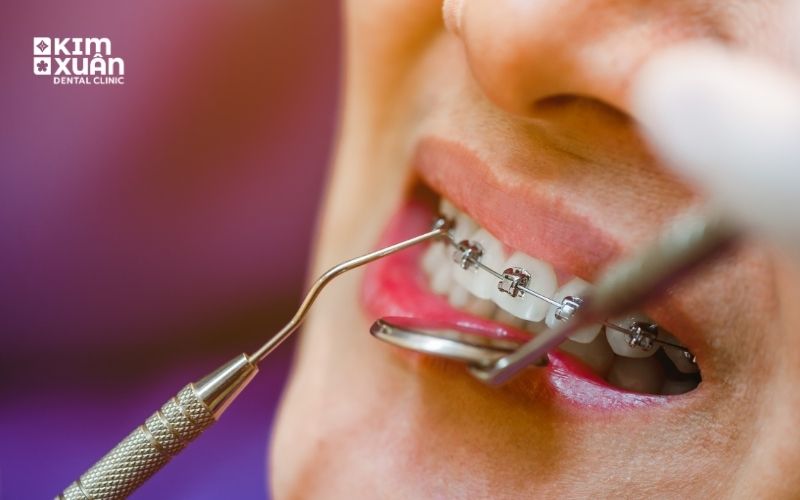 Niềng Răng Mắc Cài Tự Buộc Có Tốt Không