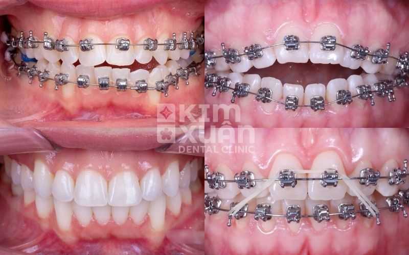 Niềng Răng Mắc Cài Tự Buộc Giá Bao Nhiêu