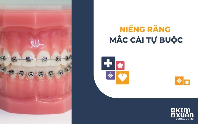Niềng Răng Mắc Cài Tự Buộc