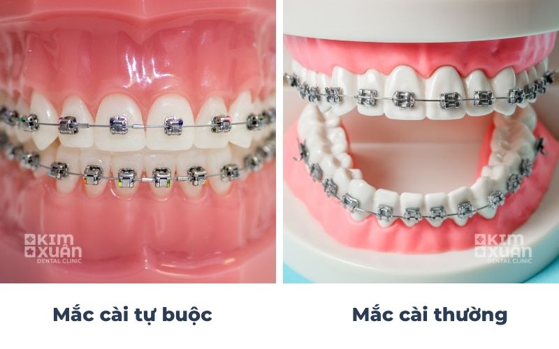 Niềng Răng Mắc Cài Tự Buộc Và Mắc Cài Thường