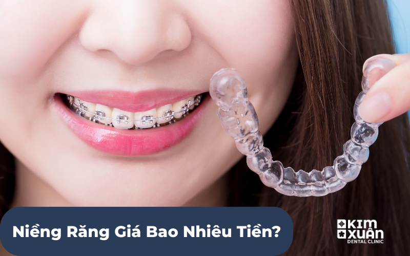 Niềng Răng Máng Trong Suốt