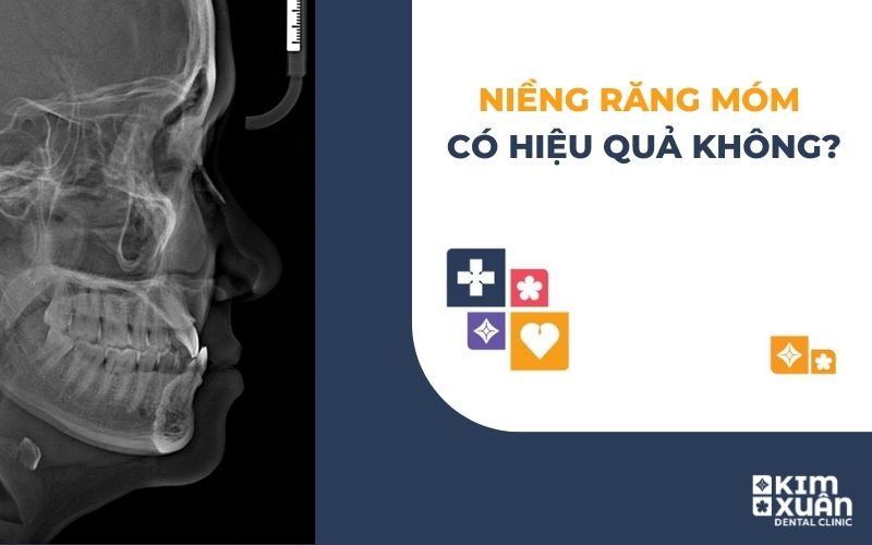 Niềng Răng Móm Có Hiệu Quả Không