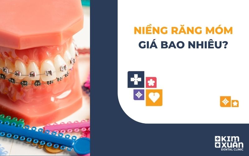 Niềng Răng Móm Giá Bao Nhiêu Tiền
