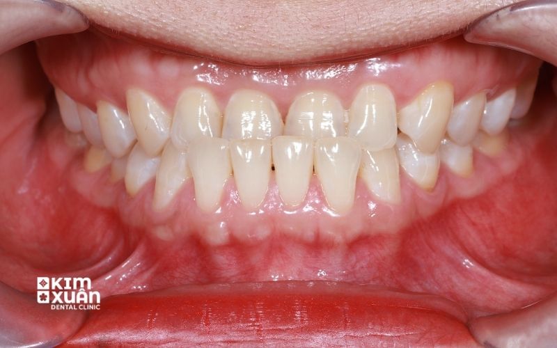 Niềng Răng Móm Là Gì