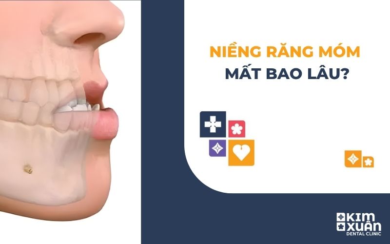niềng Răng Móm Mất Bao Lâu
