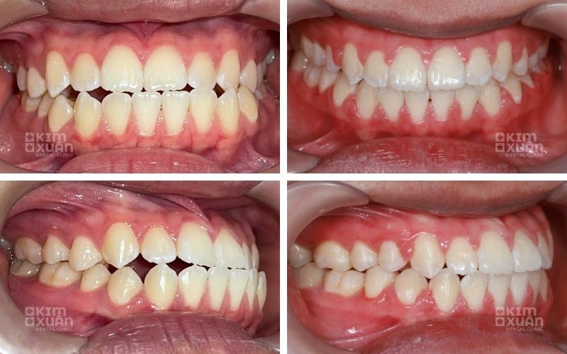 Niềng Răng Móm Mất Bao Lâu