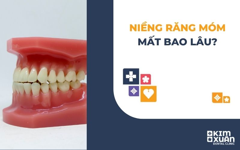 Niềng Răng Móm Mất Bao Lâu