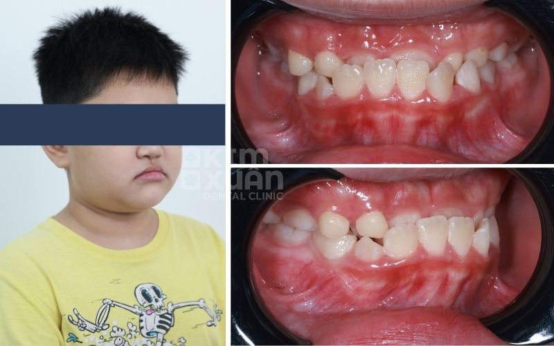 Niềng Răng Móm Tại Nha Khoa Kim Xuân