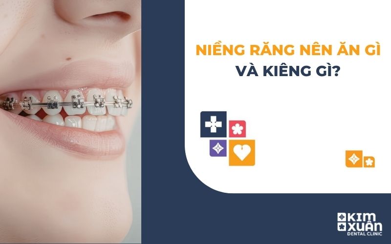 Niềng Răng Nên Ăn Gì Kiêng Gi