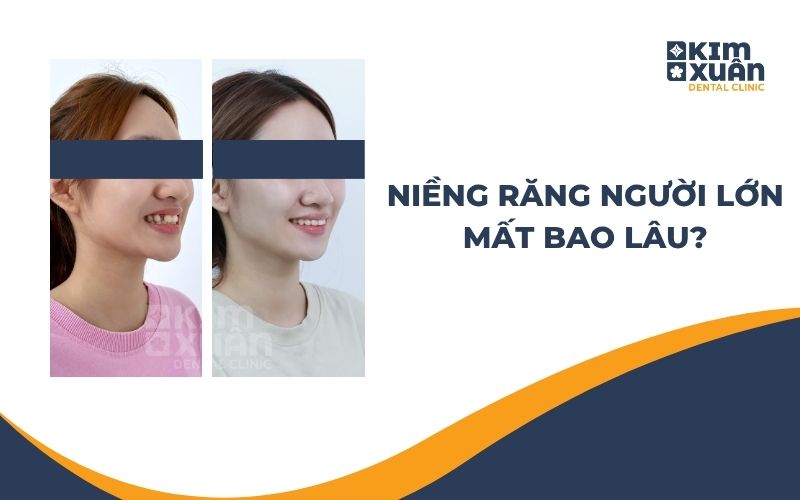 Niềng Răng Người Lớn Mất Bao Lâu