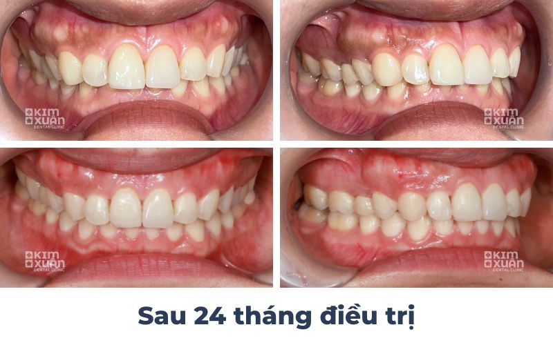 Niềng răngnguoiwf lớn sau 24 tháng tại nha khoa kim xuân