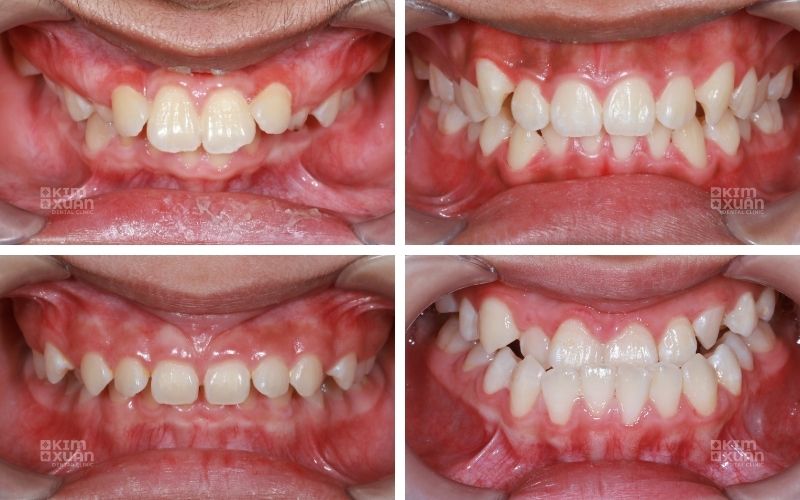 Niềng răng ở tuổi 15 tại Nha Khoa Kim Xuân