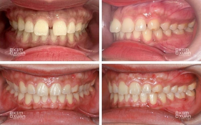Niềng Răng Thưa 2 Răng Cửa
