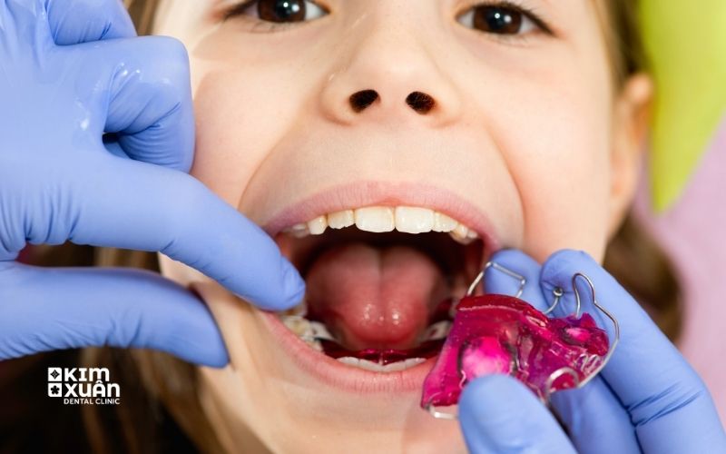 Niềng Răng Trẻ Em Giá Bao Nhiêu Tiền