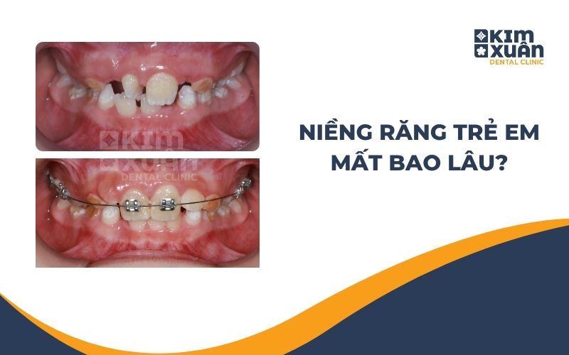 Niềng Răng Trẻ Em Mất Thời Gian Bao Lâu