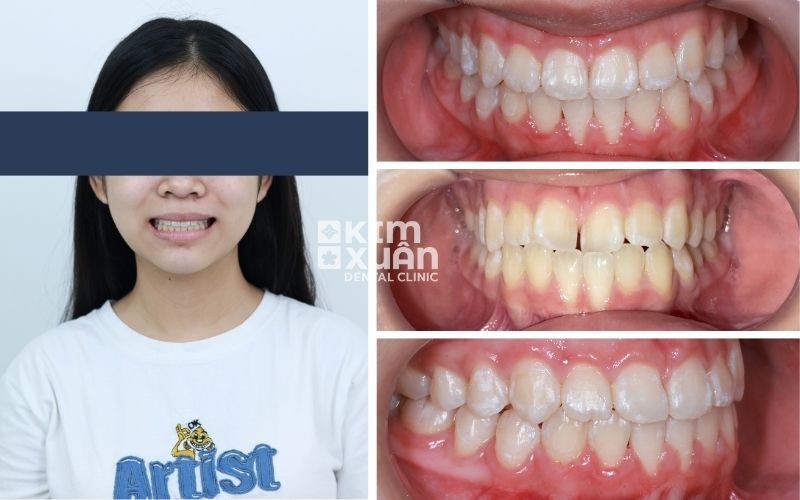 Niềng Răng Trẻ Em Tại Nha Khoa Kim Xuân