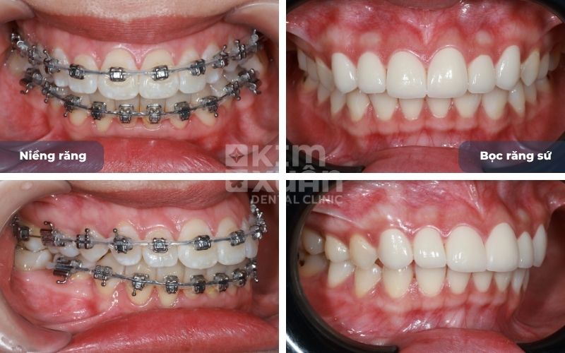 Niềng Răng và Bọc Răng Sứ Giá Bao Nhiêu