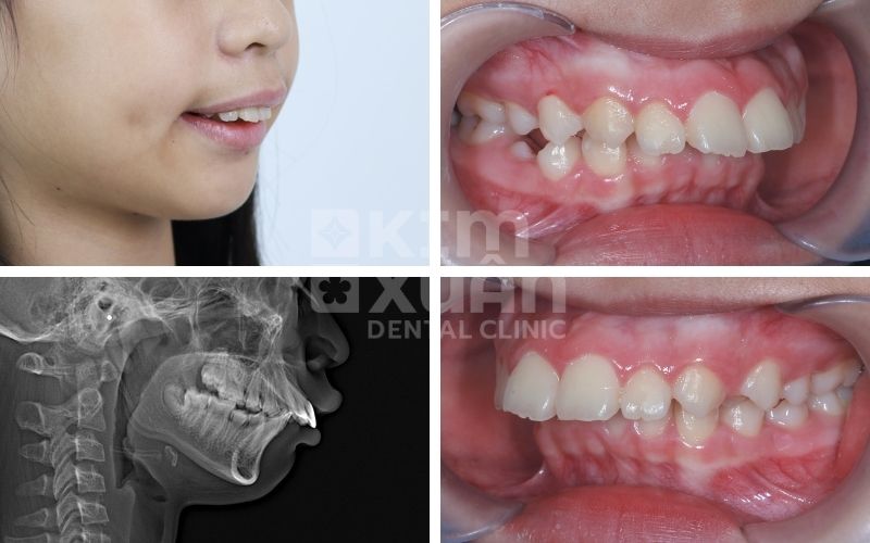 Niềng Răng Vẩu Giá Bao Nhiêu