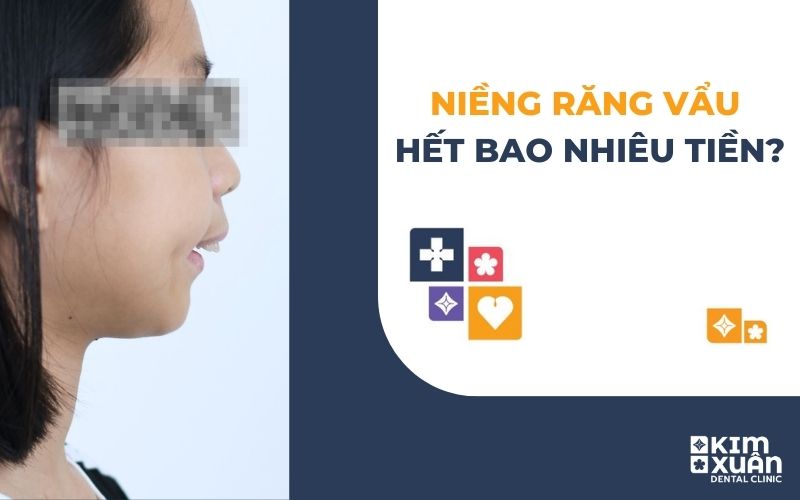 Niềng Răng Vẩu Giá Bao Nhiêu Tiền