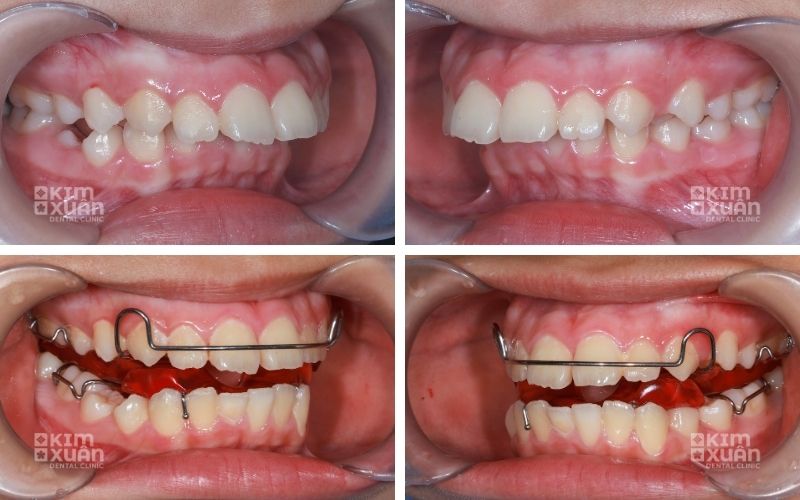 Niềng Răng Vẩu Giá Bao Nhiêu Tiền