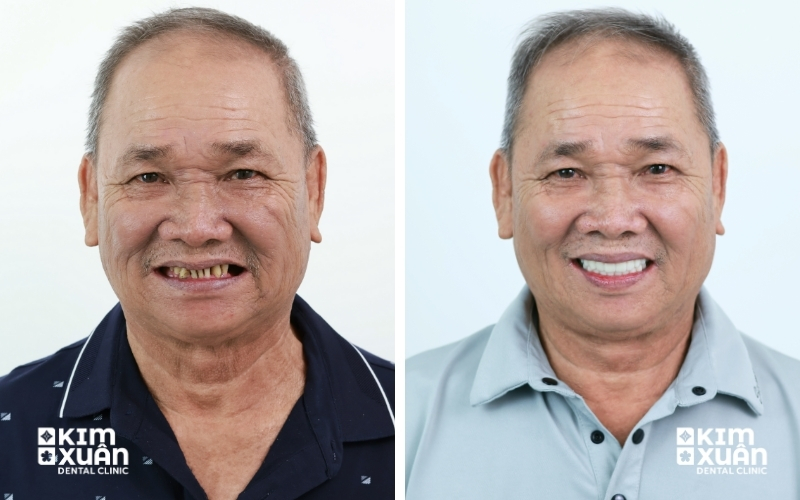 Phục Hình Implant Toàn Hàm Trước Và Sau Nha Khoa Kim Xuân