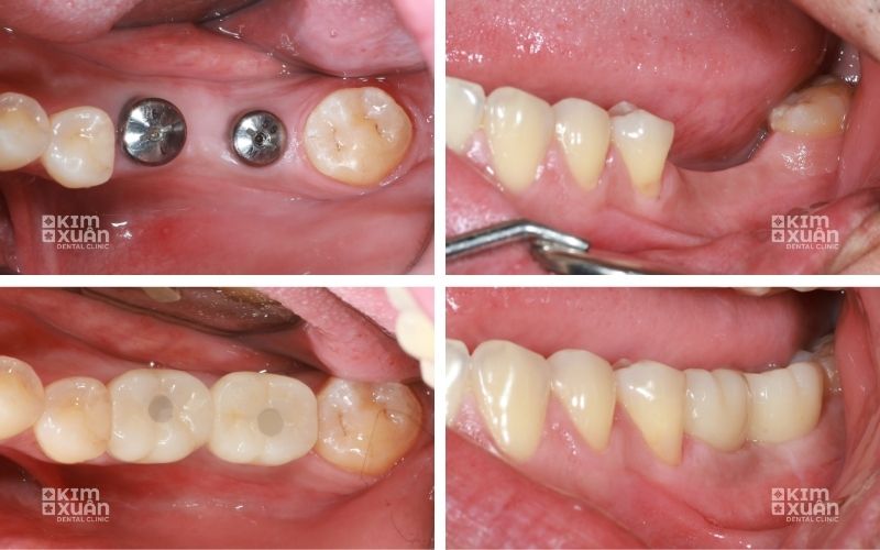 Hình ảnh trước và sau phục hình vùng răng hàm bằng Implant tại Nha khoa Kim Xuân.