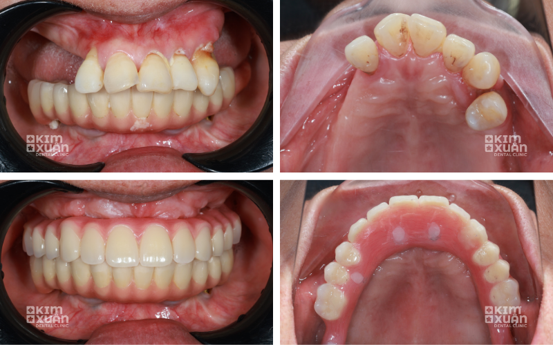 Hình ảnh trước và sau phục hình răng hàm bằng Implant tại Nha khoa Kim Xuân