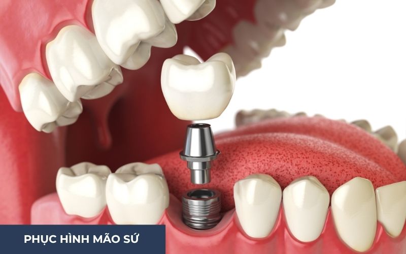 Phục Hình Răng Sứ Trên Implant